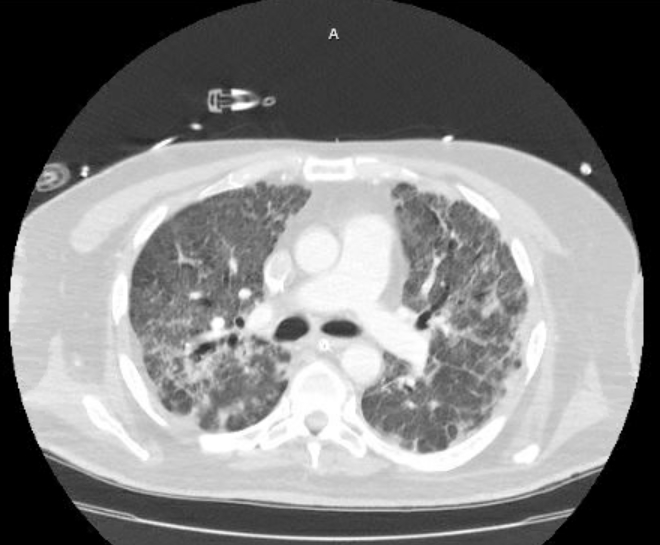 Acute cor pulmonale (ultrasound) (Radiopaedia 83508-98818 Axial lung window 38).jpg