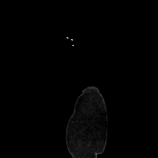Acute diverticulitis - transverse colon (Radiopaedia 87063-103327 Sagittal C+ portal venous phase 238).jpg