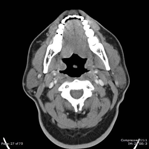 Acute epiglottitis (Radiopaedia 54375-60590 Axial C+ arterial phase 27).jpg