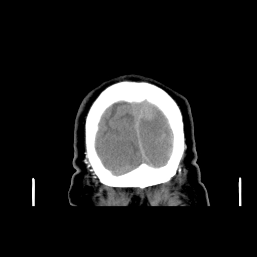 File:Acute hemorrhagic stroke (Radiopaedia 17507-17223 Coronal non-contrast 54).jpg