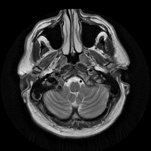 File:Acute internal carotid artery dissection (Radiopaedia 53541-59632 Axial T2 4).jpg