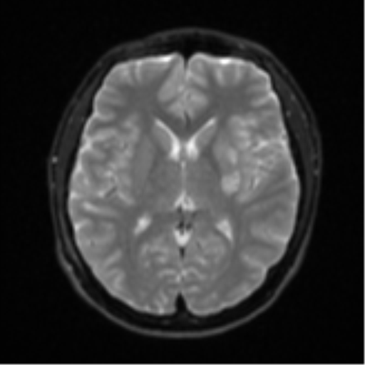 Acute left middle cerebral artery territory infarct with clot retrieval (Radiopaedia 47732-52433 Axial DWI 16).png