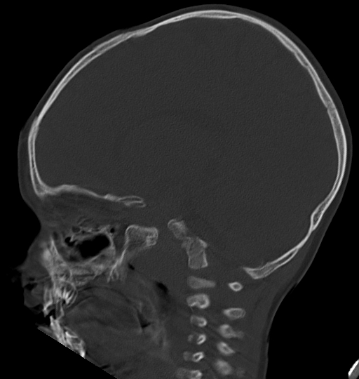 Acute mastoiditis (Radiopaedia 82678-96881 Sagittal bone window 27).jpg