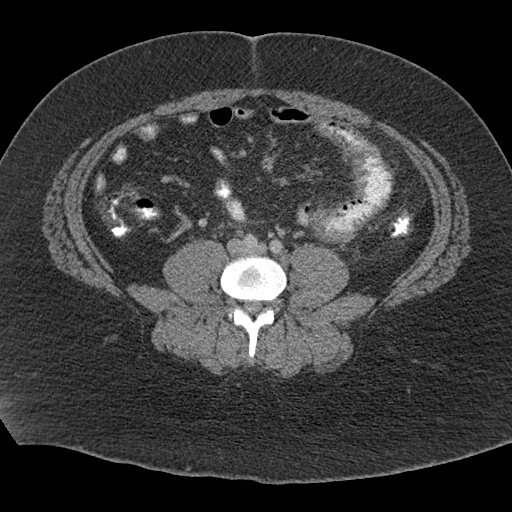 Acute mesenteric venous ischemia (Radiopaedia 46041-50383 Axial C+ portal venous phase 81).jpg