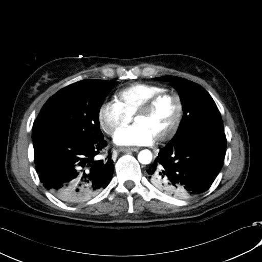 Acute myocardial infarction in CT (Radiopaedia 39947-42415 Axial C+ arterial phase 89).jpg