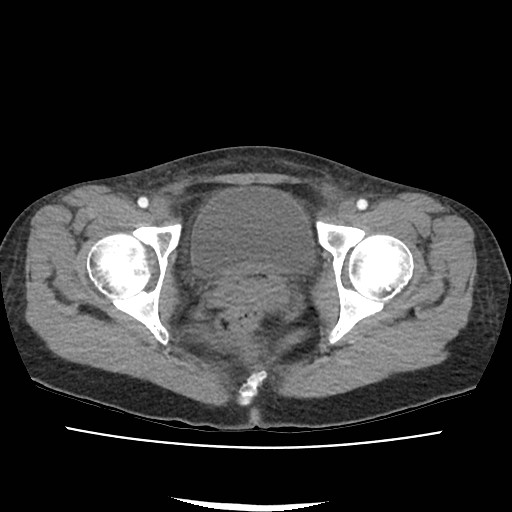 Acute myocarditis (Radiopaedia 55988-62613 Axial C+ portal venous phase 77).jpg