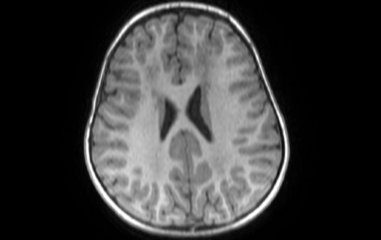 Acute necrotizing encephalitis of childhood (Radiopaedia 67356-76737 Axial T1 32).jpg