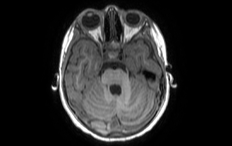 File:Acute necrotizing encephalitis of childhood (Radiopaedia 67356-76737 Axial T1 69).jpg
