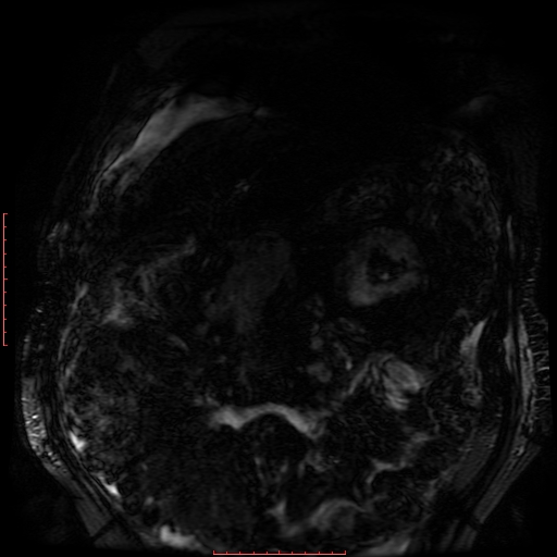 Acute necrotizing pancreatitis (Radiopaedia 28194-28448 Coronal MRCP 84).jpg