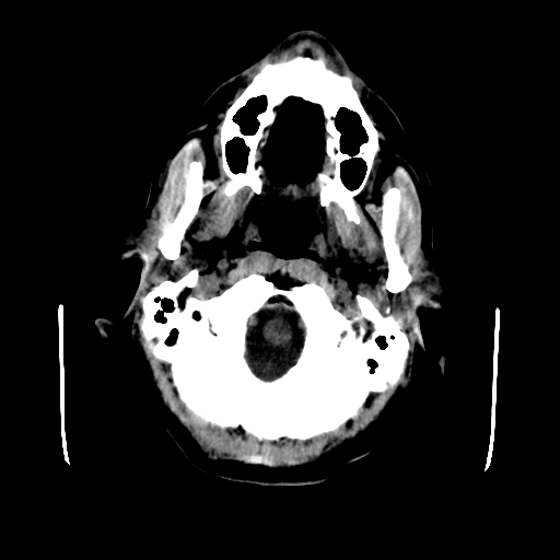 File:Acute necrotizing toxoplasma encephalitis (Radiopaedia 10683-11150 Axial non-contrast 32).jpg
