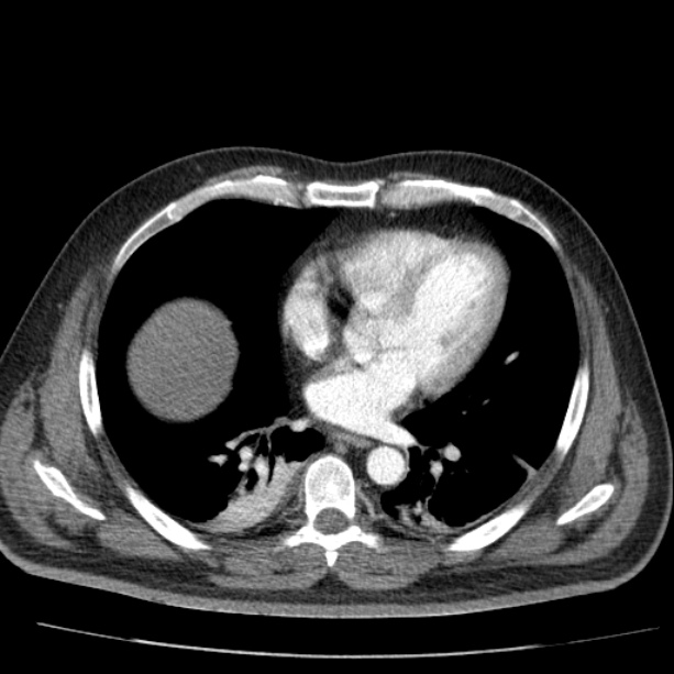 Acute pancreatitis (Radiopaedia 26663-26813 Axial C+ arterial phase 7).jpg