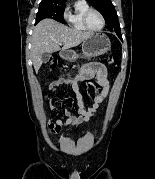 File:Acute pancreatitis (Radiopaedia 87428-103757 Coronal C+ portal venous phase 27).jpg