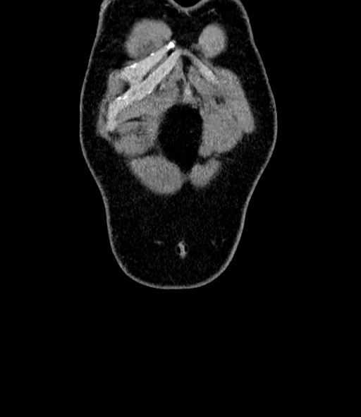 Acute pancreatitis (Radiopaedia 87428-103757 Coronal C+ portal venous phase 3).jpg