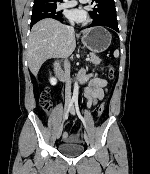 Acute pancreatitis (Radiopaedia 87428-103757 Coronal C+ portal venous phase 48).jpg