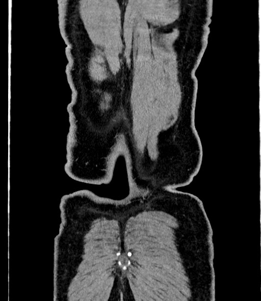 Acute pancreatitis (Radiopaedia 87428-103757 Coronal C+ portal venous phase 90).jpg