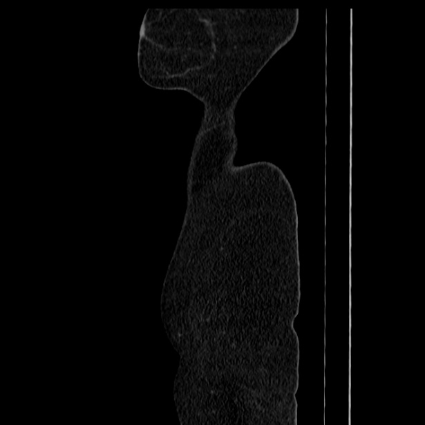 Acute pancreatitis - Balthazar C (Radiopaedia 26569-26714 Sagittal C+ portal venous phase 69).jpg