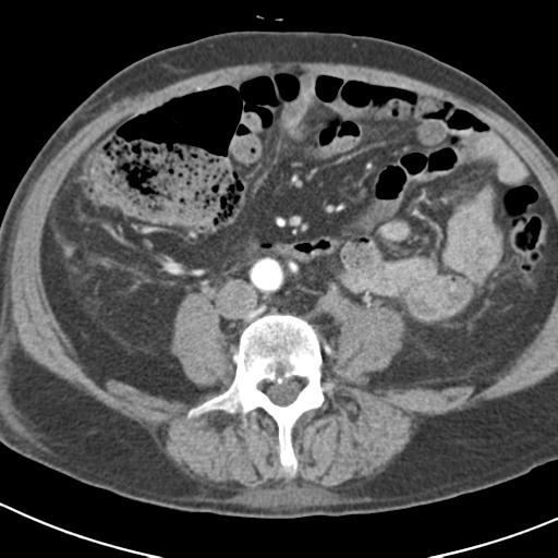 File:Acute pancreatitis and walled-off necrosis (Radiopaedia 29888-30403 Axial C+ portal venous phase 36).jpg