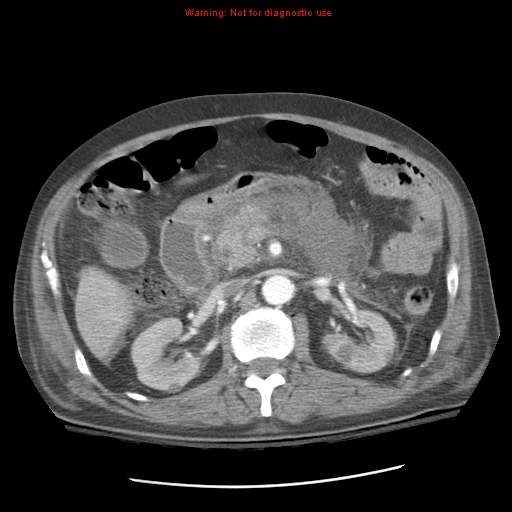 File:Acute pancreatitis with incidental pancreatic lipoma (Radiopaedia 10190-10730 Axial C+ arterial phase 42).jpg