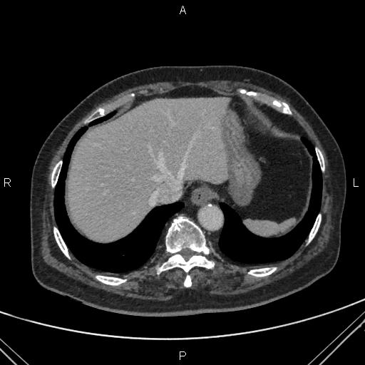 Acute renal artery occlusion (Radiopaedia 86586-102682 Axial C+ portal venous phase 5).jpg