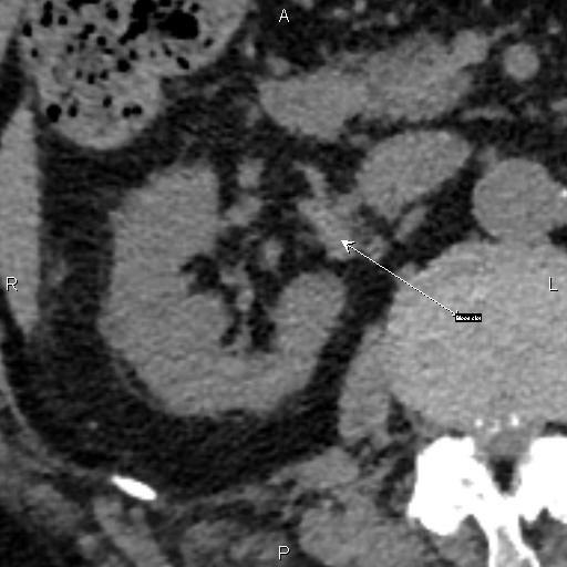 File:Acute renal artery occlusion (Radiopaedia 86586-102714 Axial 1).jpg