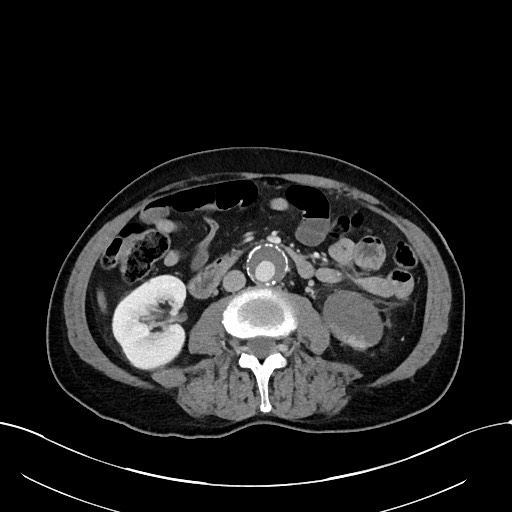 File:Acute renal infarction (Radiopaedia 59375-66736 Axial C+ portal venous phase 51).jpg