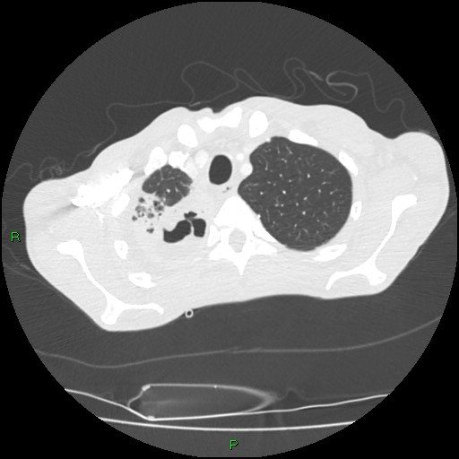 File:Acute right lung abscess (Radiopaedia 34806-36258 Axial lung window 27).jpg