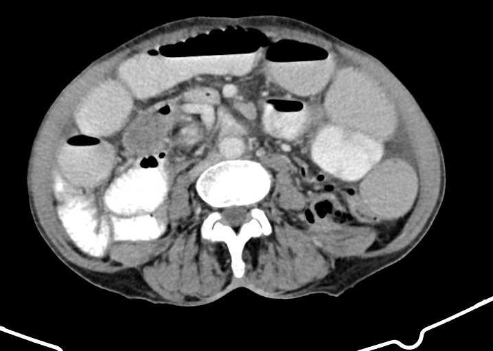 Acute small bowel (ileal) volvulus (Radiopaedia 71740-82139 Axial C+ portal venous phase 117).jpg
