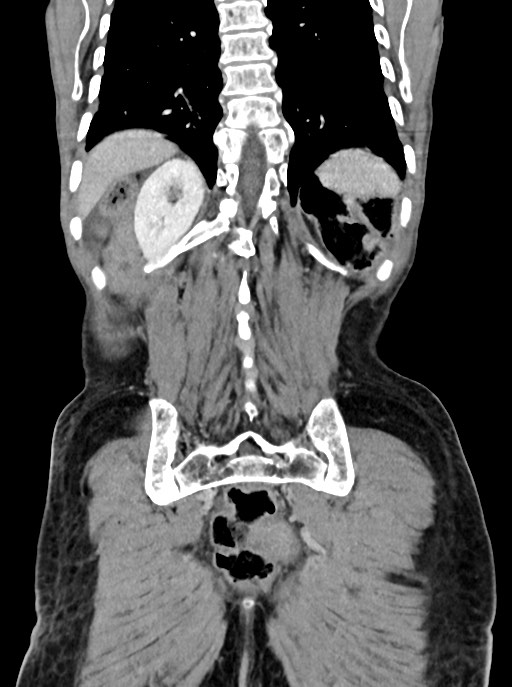 Acute small bowel (ileal) volvulus (Radiopaedia 71740-82139 Coronal C+ portal venous phase 92).jpg