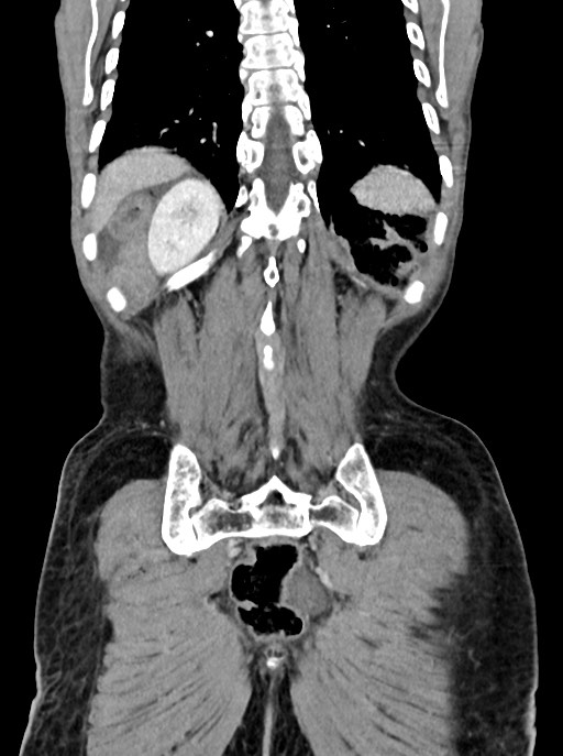 Acute small bowel (ileal) volvulus (Radiopaedia 71740-82139 Coronal C+ portal venous phase 94).jpg