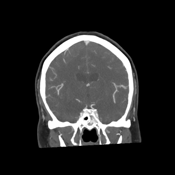 Acute subarachnoid hemorrhage and accessory anterior cerebral artery (Radiopaedia 69231-79009 Coronal C+ arterial phase 41).jpg