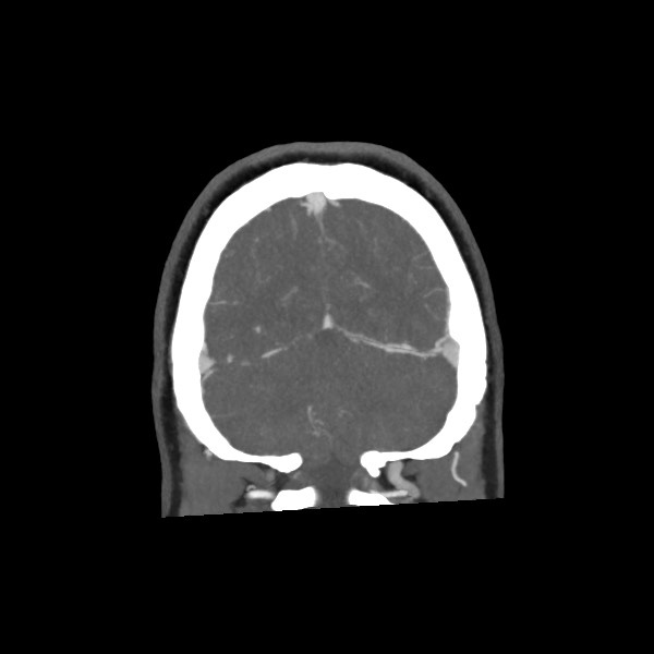 Acute subarachnoid hemorrhage and accessory anterior cerebral artery (Radiopaedia 69231-79009 Coronal C+ arterial phase 68).jpg