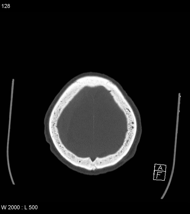 Acute subdural hematoma with myelofibrosis (Radiopaedia 52582-58494 Axial bone window 64).jpg