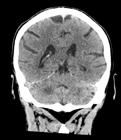 Acute superior cerebellar artery territory infarct (Radiopaedia 84104-99359 Coronal non-contrast 61).jpg