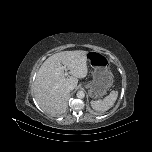 Acute superior mesenteric artery occlusion (Radiopaedia 51288-56960 Axial C+ portal venous phase 20).jpg