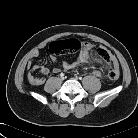 File:Acute traumatic mesenteric bleed (Radiopaedia 37561-39428 Axial C+ portal venous phase 111).jpg