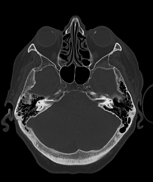 Acute traumatic subdural hematoma (Radiopaedia 82921-97257 Axial bone window 79).jpg