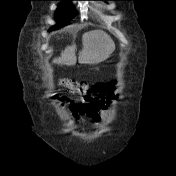 Acute tubular necrosis (Radiopaedia 28077-28334 D 17).jpg