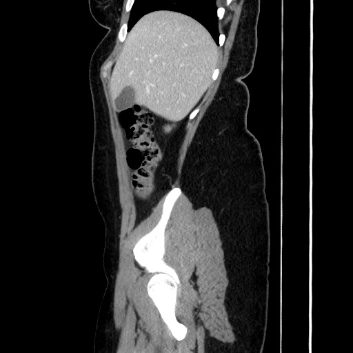 Acute uncomplicated appendicitis (Radiopaedia 73704-84499 Sagittal C+ portal venous phase 64).jpg