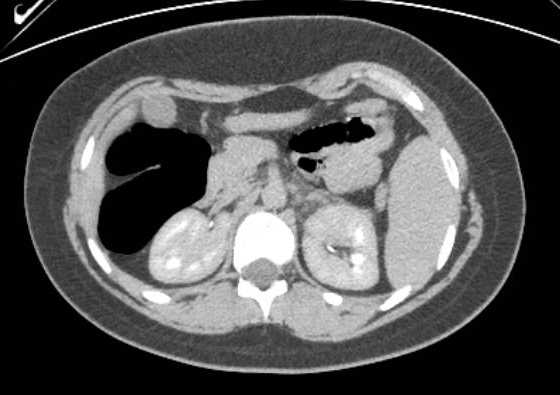 Acute unilateral nonhemorrhagic adrenal infarction (Radiopaedia 67560-76957 Axial renal excretory phase 56).jpg