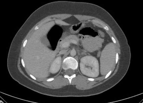 Acute unilateral nonhemorrhagic adrenal infarction (Radiopaedia 67560-76957 Axial renal parenchymal phase 44).jpg