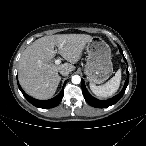 File:Adenocarcinoma of the lung (Radiopaedia 59871-67325 Axial C+ arterial phase 88).jpg