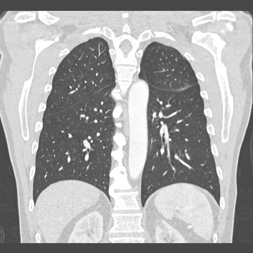 Adenocarcinoma of the lung (Radiopaedia 59871-67325 Coronal lung window 43).jpg