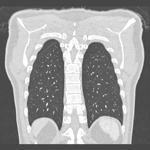Adenocarcinoma of the lung (Radiopaedia 59871-67325 Coronal lung window 54).jpg