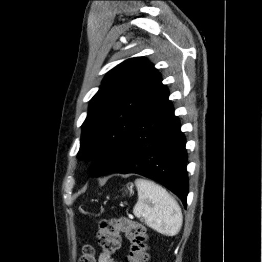 Adenocarcinoma of the lung (Radiopaedia 59871-67325 Sagittal C+ arterial phase 87).jpg