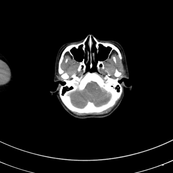 Adenocystic carcinoma of the trachea (Radiopaedia 47677-52525 Axial C+ arterial phase 3).jpg