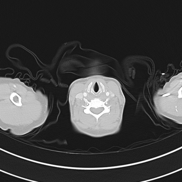 Adenocystic carcinoma of the trachea (Radiopaedia 47677-52525 Axial lung window 21).jpg