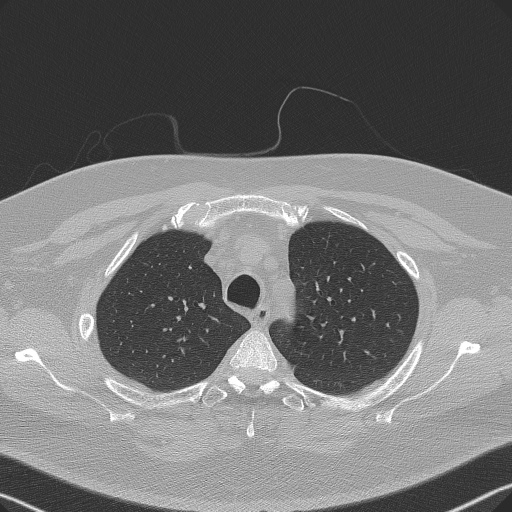 File:Adenoid cystic carcinoma of the trachea (Radiopaedia 49042-54137 Axial lung window 78).jpg
