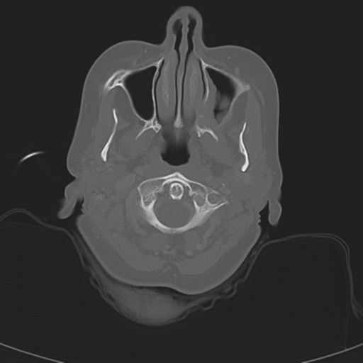 File:Adenoid cystic tumor of palate (Radiopaedia 46980-51518 Axial bone window 25).png