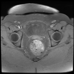 File:Adenomyosis within a didelphys uterus (Radiopaedia 70175-80215 Axial T1 fat sat 31).jpg