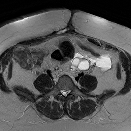 File:Adenomyosis within a didelphys uterus (Radiopaedia 70175-80215 Axial T2 4).jpg